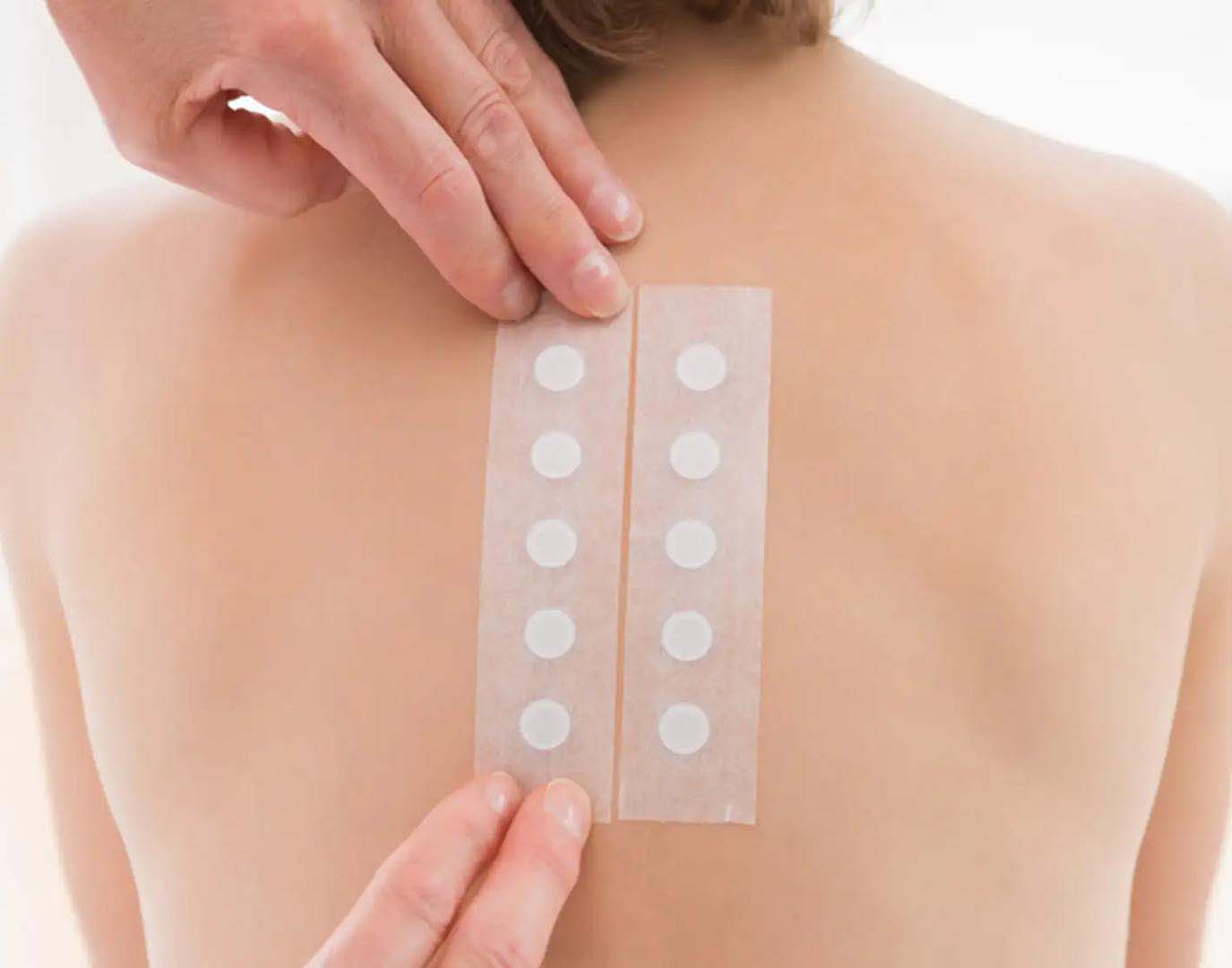 F&eacute;mallergia diagnosztiz&aacute;l&aacute;sa epicutan allergiateszt seg&iacute;ts&eacute;g&eacute;vel