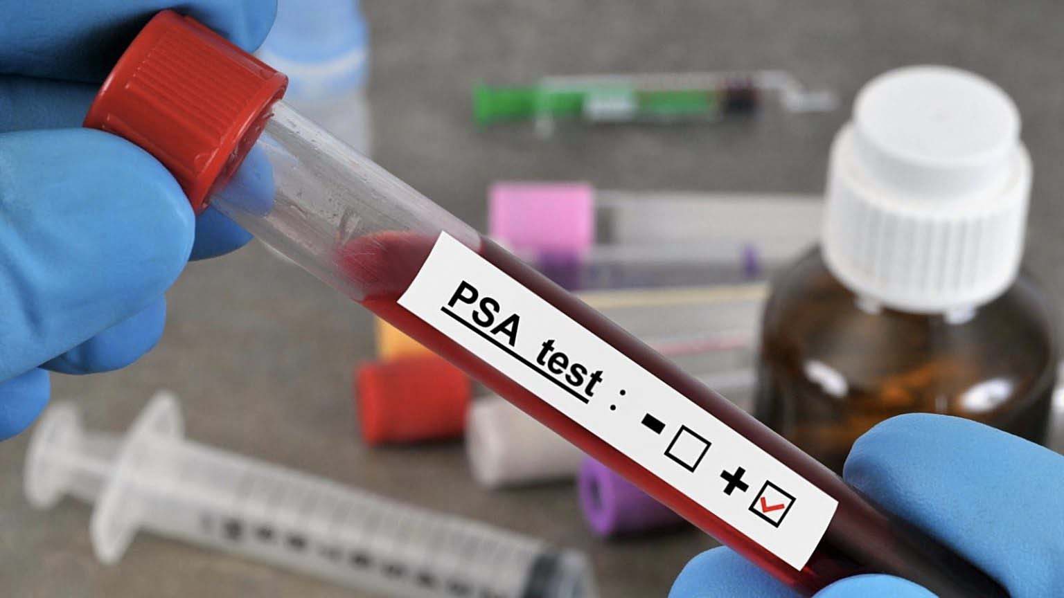 Prosztataszűr&eacute;s &ndash; Kinek? Mikor? Mi&eacute;rt?